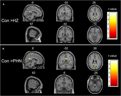 Abnormal Intrinsic Brain Activity and Neuroimaging-Based fMRI Classification in Patients With Herpes Zoster and Postherpetic Neuralgia